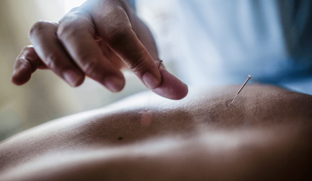 Acupuncture treatment in Winter Park Florida