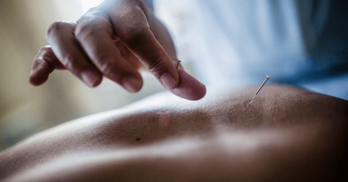 Acupuncture treatment in Winter Park Florida