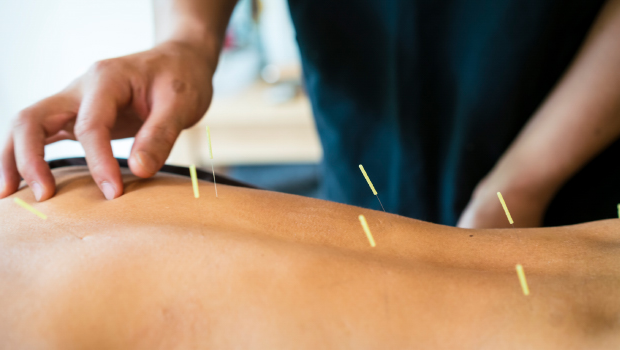 The Ancient Art of Acupuncture: A Holistic Approach to Healing