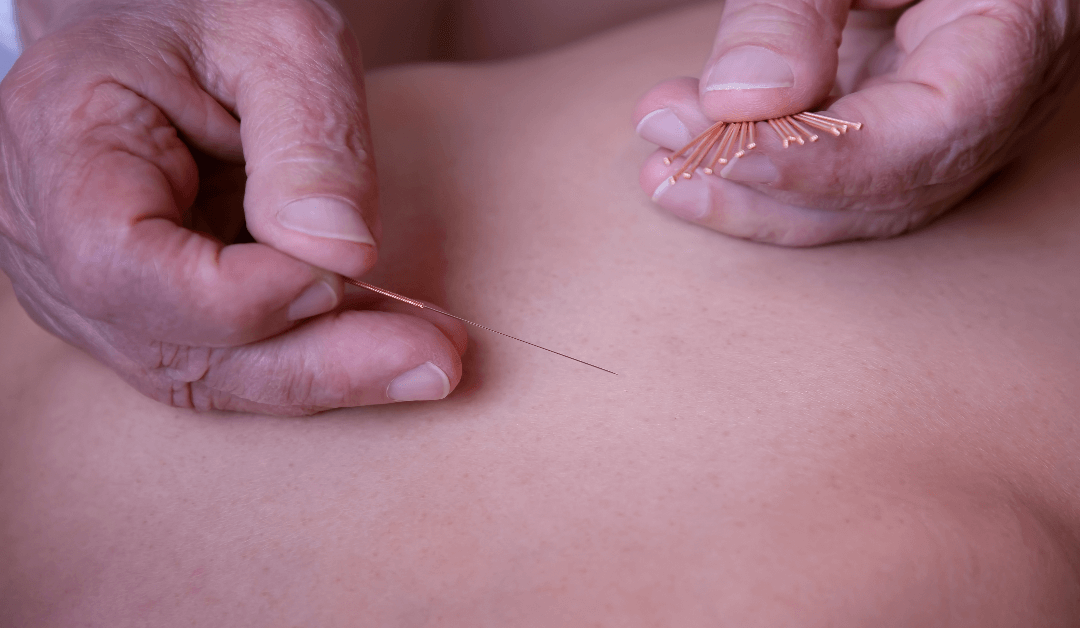 Winter park Chiropractic | Benefits of Acupuncture
