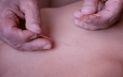 Healing Naturally: The Remarkable Benefits of Acupuncture