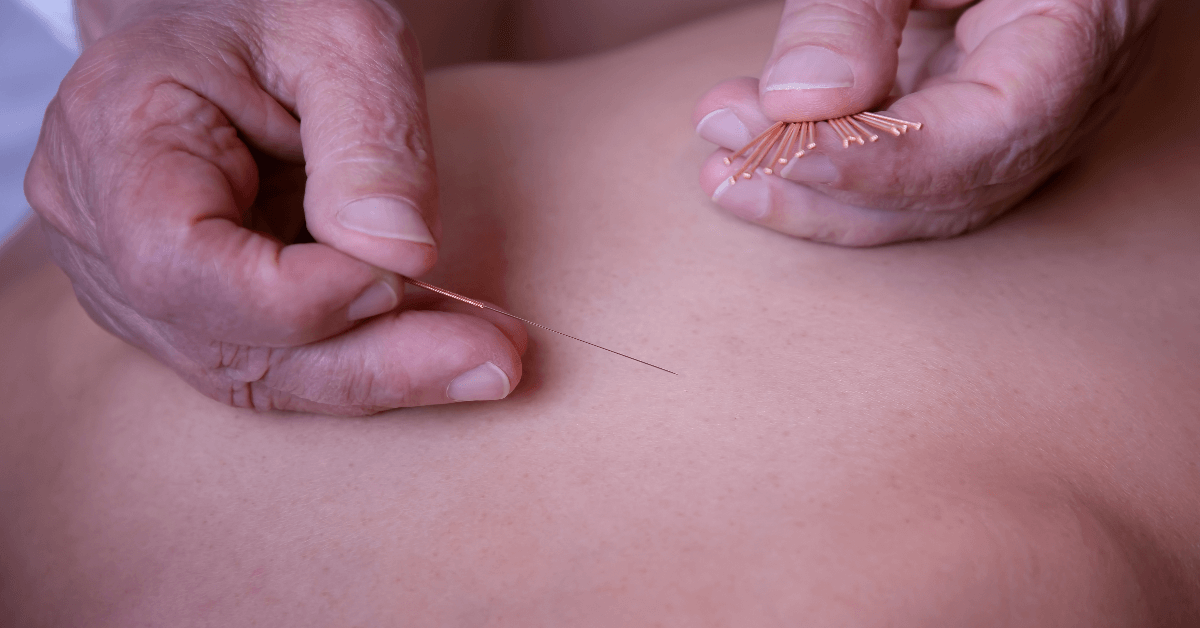 Winter park Chiropractic | Benefits of Acupuncture