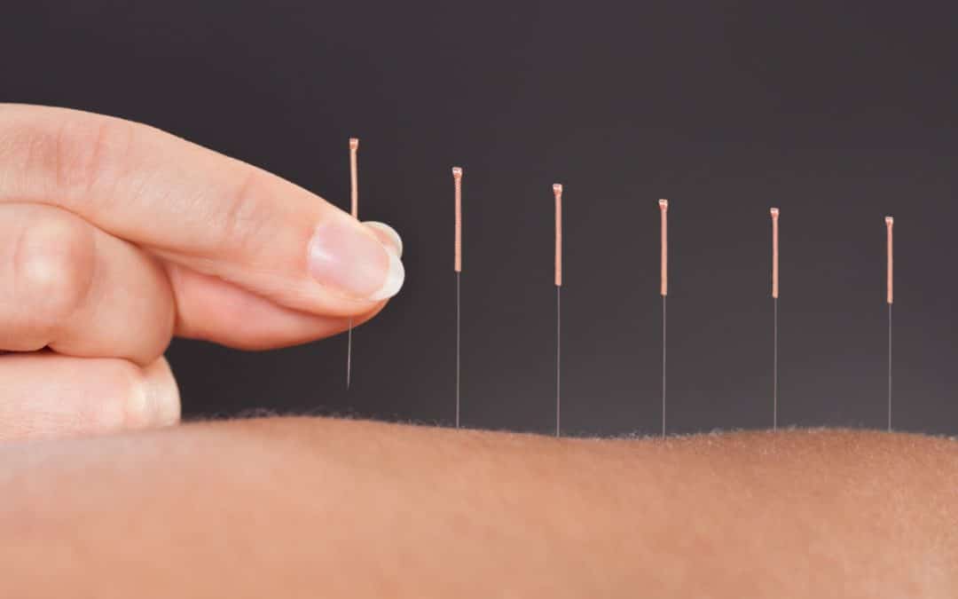 Acupuncture Florida