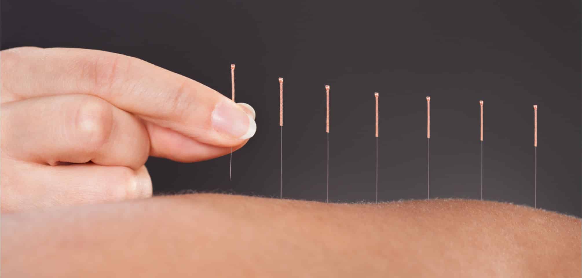 Acupuncture Florida