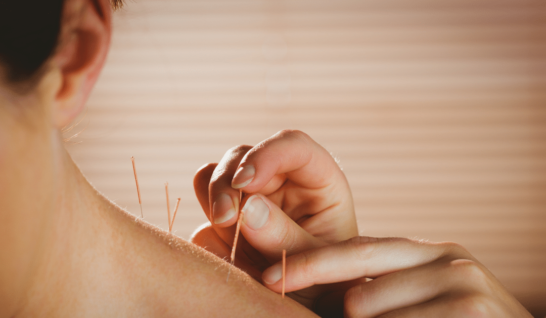 Acupuncture Near Me
