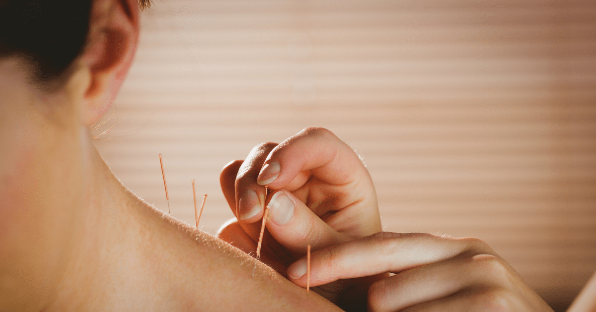 Acupuncture Near Me