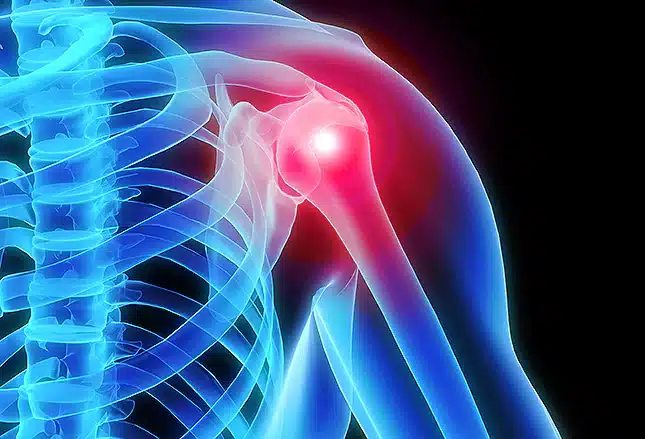 Shoulder Pain Chiropractor – Expert Care at Winter Park