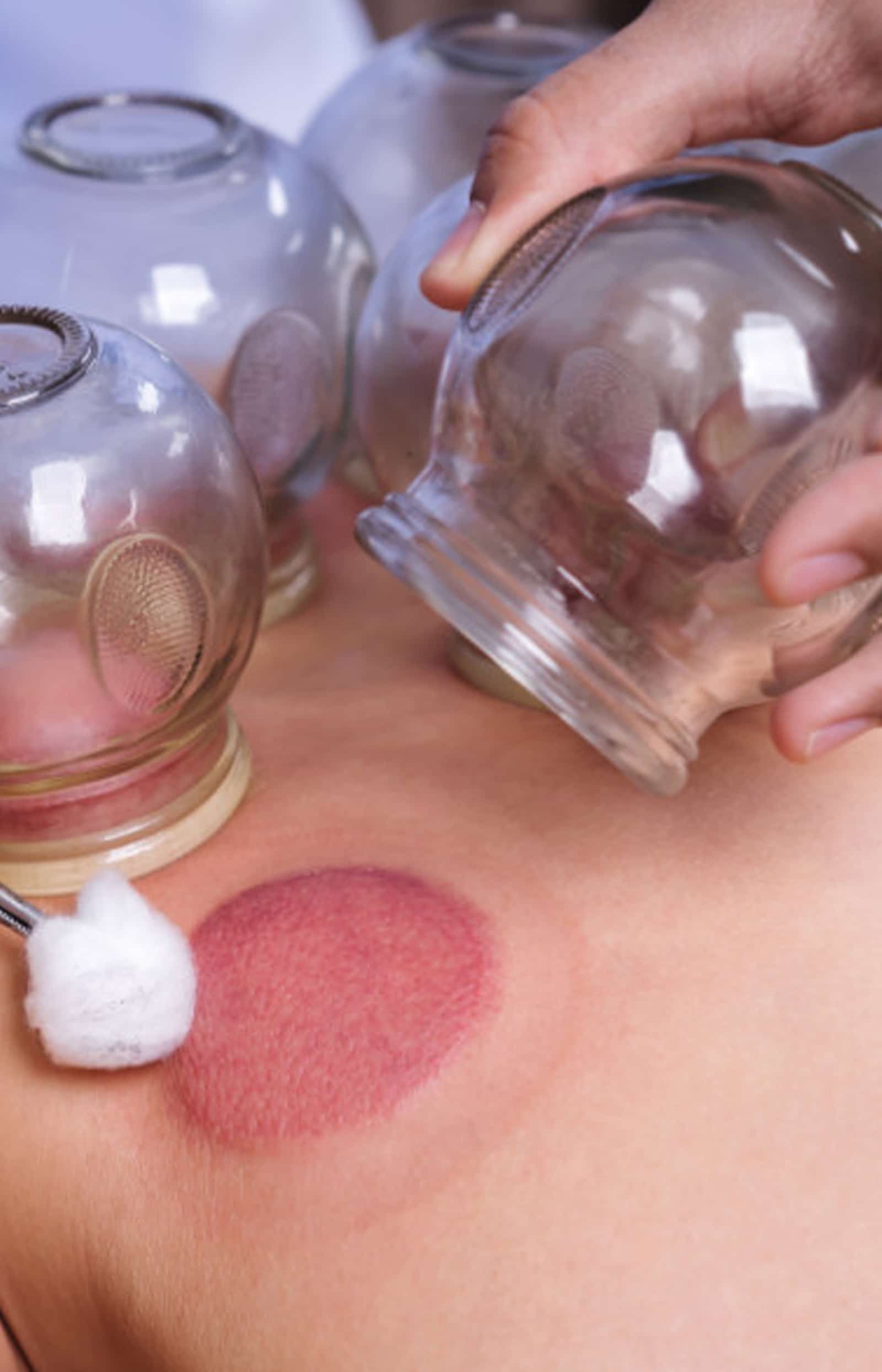 Chinese Cups Therapy