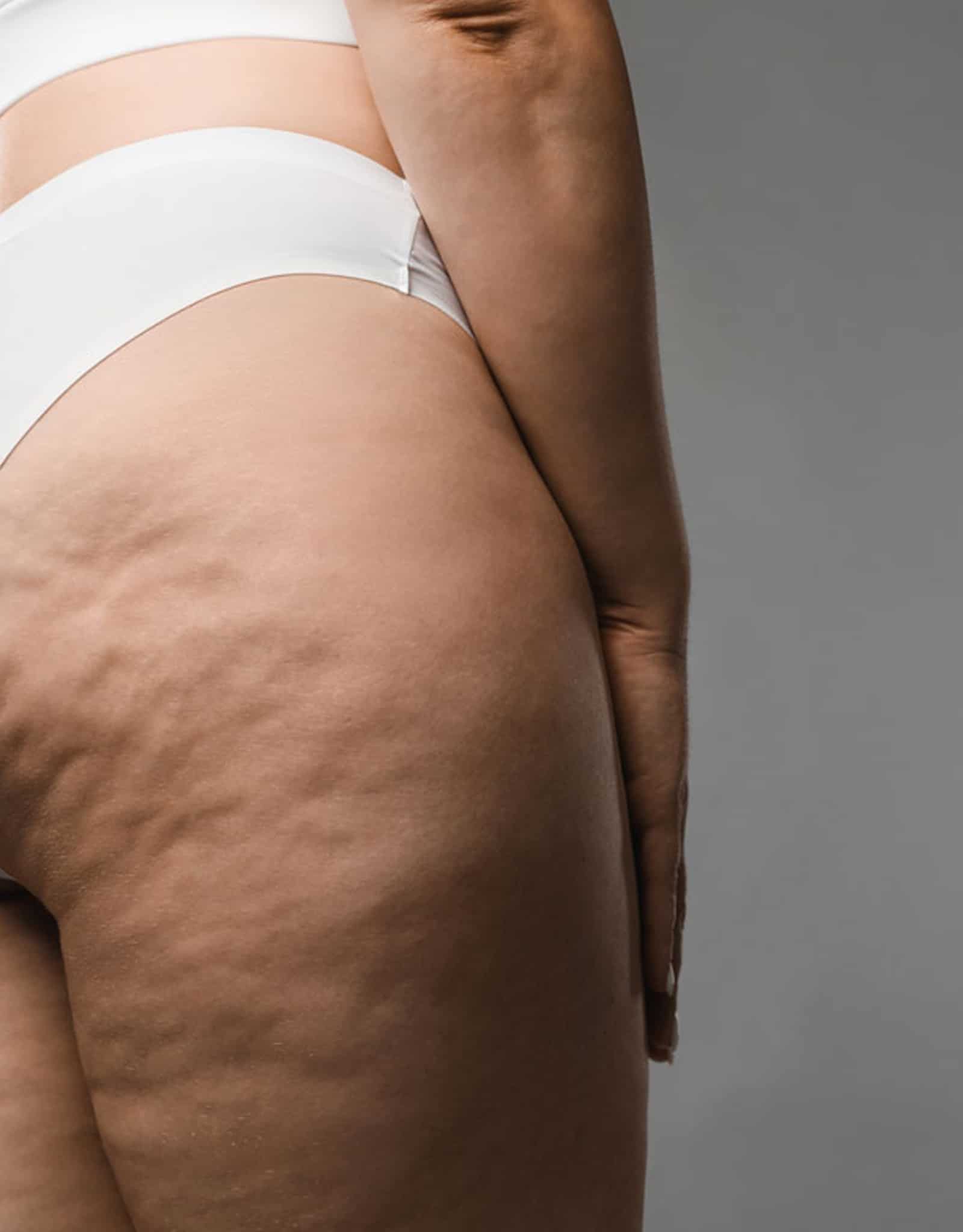 tissue septae and fat lobules contribute