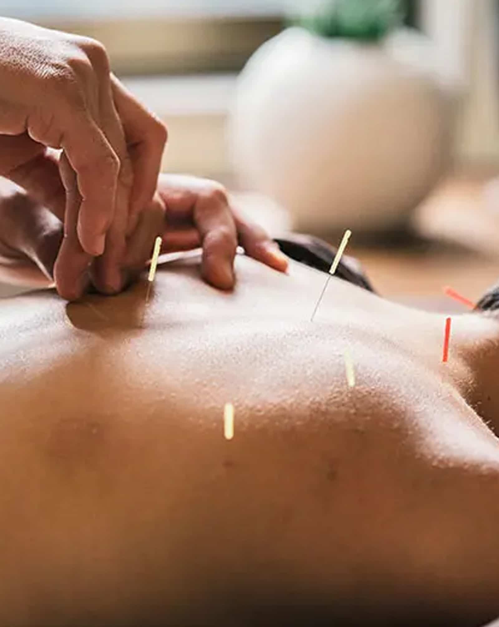 Acupuncture A Neurophysiological Approach