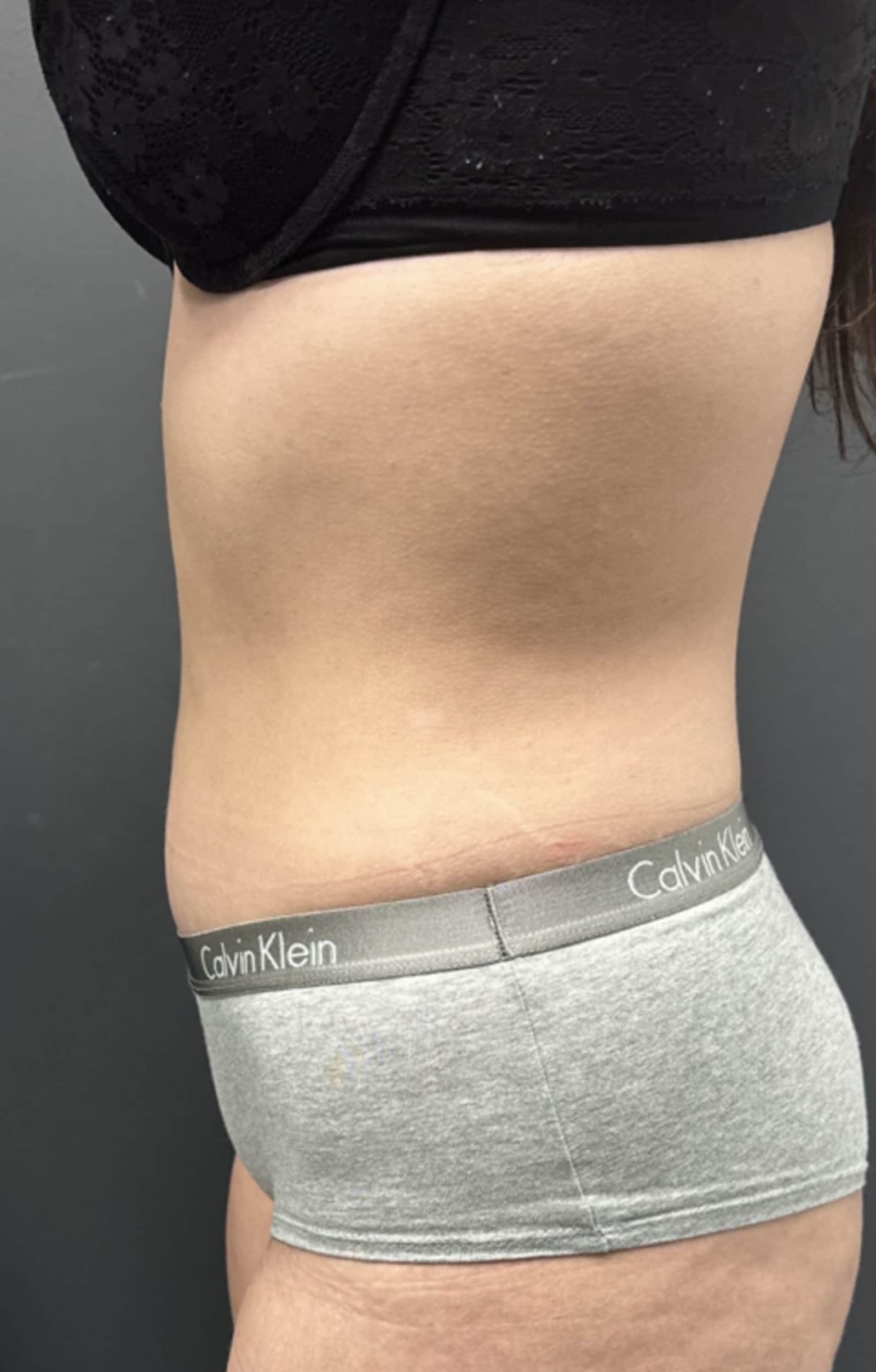 Skin Tightening with Radiofrequency Therapy