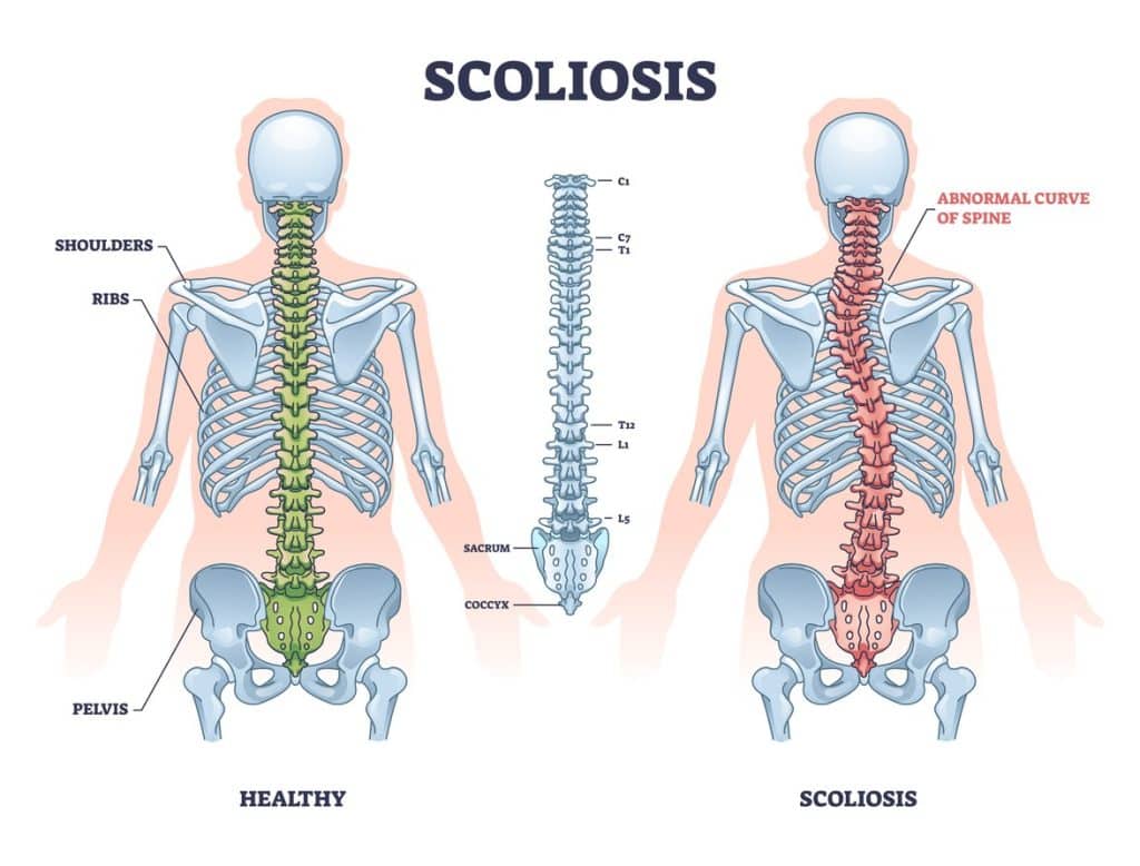 scoliosis treatment winter park chiropractic
